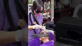 Tattoo Laser Removal