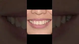 Profile improvement with braces