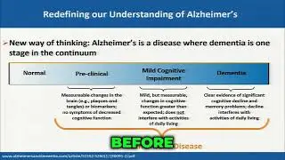 The Silent Invasion: Alzheimer's Starts Years Before You Notice a Single Symptom!