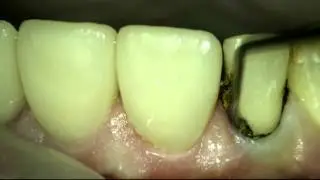 Gingival retraction