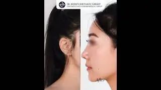 Natural-Looking Rhinoplasty Using Rib Cartilage | Dr. Kenneth Kim Plastic Surgery