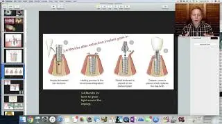 Implant   Basic Introduction. Education for dental staff.