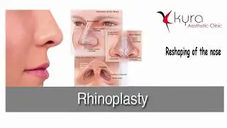 Cost of Rhinoplasty in Punjab, Ludhiana, Chandigarh - Kyra Clinic