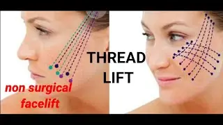 Non-surgical Thread Facelift  india indore mumbai delhi ahmedabad lucknow raipur bhopal nagpur goa