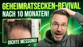 10 Monate nach Haartransplantation: Das Ergebnis ist KRASS!