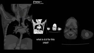Child with swelling, what is D.D ?#radiology # 