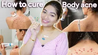 How to get rid of body acne fast | Backacne | Medic Akanshya