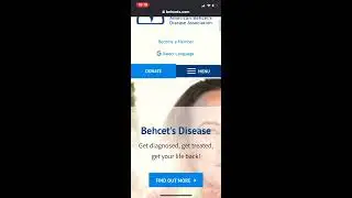 Bechets Disease