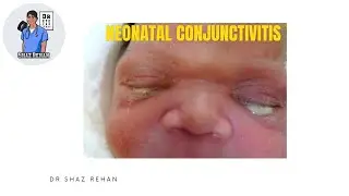 Neonatal Conjunctivitis. Is it SERIOUS? Eye Dr Explains.