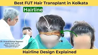 Best FUT hair transplant in Kolkata | Hair Line design explained | Cosmo Aid | Dr. Nagwani
