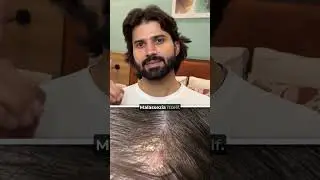 What's the root cause of Dandruff & What's the Solution? | Bare Anatomy Anti Dandruff Shampoo Review