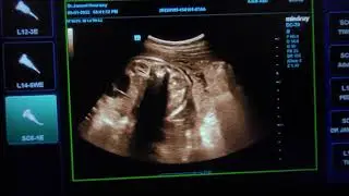 Fetal Hepatic Complex  Cystic Lesion