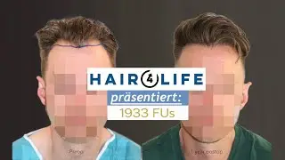 Haarausfall & Geheimratsecken &ndash; FUE Haartransplantation | Vorher-Nachher Ergebnis | 1993 FUs