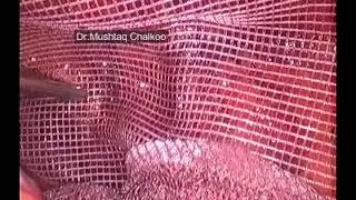 lap tapp for right inguinal hernia using 2 D parietex mesh