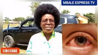 Dr. Musenero Speaks out on Red eye disease outbreak + Prevention and Treatment
