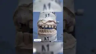 #3d #dentist #3dprinting #اكسبلور #exocad #anatomy #turkey #food #ابداع #dentistry #dentist #zircone