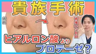 【貴族手術】鼻翼基部の凹みはヒアルロン酸とプロテーゼのどちらで治療すべきか