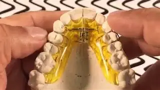La Expansión Alveolar de las arcadas dentales (video 2 de 3)
