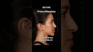 Best Natural Rhinoplasty Results- Before & After ✨ Beverly Hills LA CA