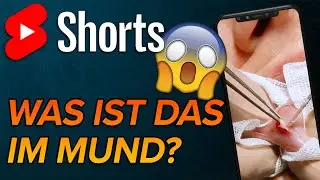 Entfernung eines Reizfibroms #shorts