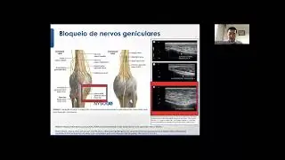 Bloqueio de nervos geniculares