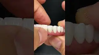 World-Class Full Mouth Zirconia Arch Implant