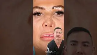 HOW TO FIX A COLLAPSED NOSE 👃 Dr. Johnson C. Lee | Beverly Hills, CA