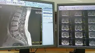 Mri ls spine kaise krte hai #mri ls ki position kaise krte h #mri kaise krte h #mri