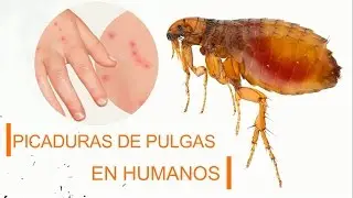 Picaduras de pulgas en humanos