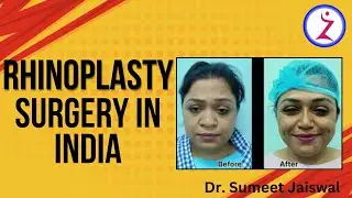 Rhinoplasty Surgery In India | Rhinoplasty Post OP | India Alarplasty - Zenith Clinic