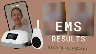 Final EMS Results - Before and After Photos!