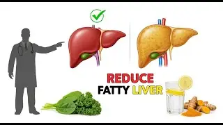 Doctor Recommended Ways to Reduce Fatty Liver, Naturally&rdquo;