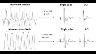 Driving motor cortex oscillations modulates bradykinesia in Parkinson&rsquo;s disease