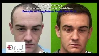 What is the best age for Hair Transplant Surgery? FUE FAQ by Dr. Umar
