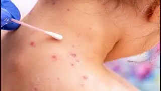 itchy pustules; small, raised bumps on the skin filled with pus that are accompanied by itching