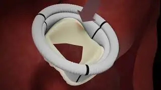 Tissue replacement heart valve
