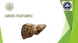 SRM Dental College, Ramapuram - Department of General Pathology Fatty Liver