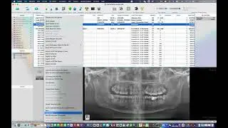 Anonymizing feature for Horos_Osirix PACS Viewer *Not for Medical Usage **