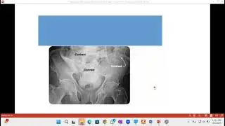 Bladder and Urethral Injury Toacs  | FCPS MS | Retrograde cystogram/urethrogram | Shahzore Laghari
