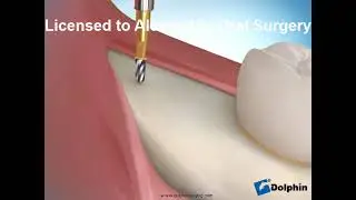 Third Molar Extraction Full Boney Impaction