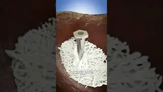 Как работают зубные имплантаты 🤔