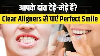 आपके दांत टेढ़े-मेढ़े हैं? Clear Aligners से पाएं Perfect Smile | Best Dentist In Jaipur