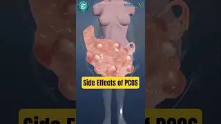 PCOS Side Effects Explained 🤯 | Periods से Weight तक! | #pcos in hindi | Dr. Shweta Mendiratta