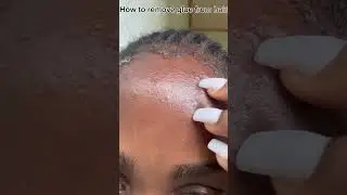 How to remove glue from hairline #glue #hairlinerestoration
