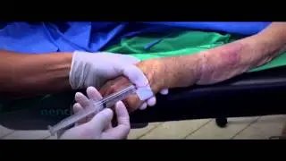 Anestesia regional endovenosa o bloqueo de Bier