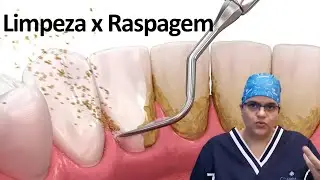 Qual a diferença entre limpeza e raspagem? | Dra Bianca Rosa | Clínica Bianca Rosa