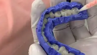 Temporaries | full mouth rehabilitation for attrited teeth| temporaries in 5 minutes