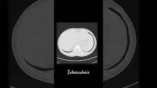 tuberculosis #radiographer #radiologist #lifescience #shorts #doctor #mbbs #bhms #radiology #dnb #ms