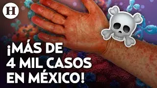 ¿Por qué regresó el Sarampión a México? Así puedes cuidarte de esta enfermedad viral