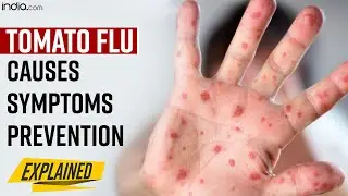 Tomato Flu: Causes, Symptoms, Prevention Tips and It&rsquo;s Relationship With Tomatoes Explained